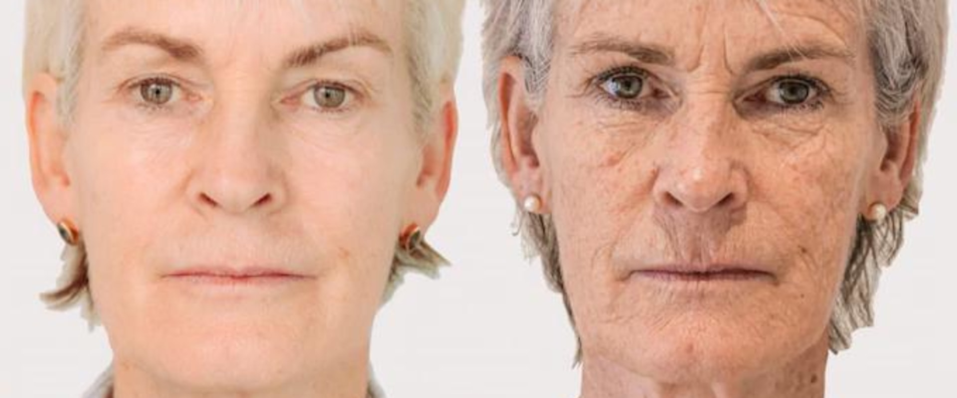 Can Botox Help Reduce Sagging Jowls can-botox-help-reduce-sagging-jowls