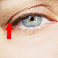 The Potential Negative Effects of Botox