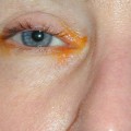 Can Botox Be Reversed? - Expert Advice on How to Correct Unwanted Results