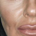 The Benefits of Botox: How It Can Change Your Face