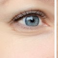 Is Botox the Answer to Your Aging Woes?