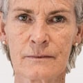 Can Botox Help Reduce Sagging Jowls?