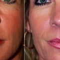 What Happens if Botox is Injected into a Vein?