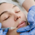 Skin Tightening, Botox and Lip Fillers by Skinsation LA: Premier Botox Treatments