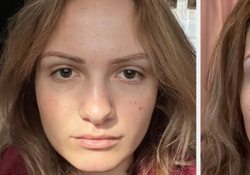 Can Botox Help Treat TMJ Disorder?