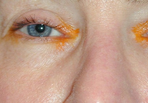 Can Botox Be Reversed? - Expert Advice on How to Correct Unwanted Results