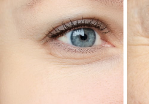 Is Botox the Answer to Your Aging Woes?