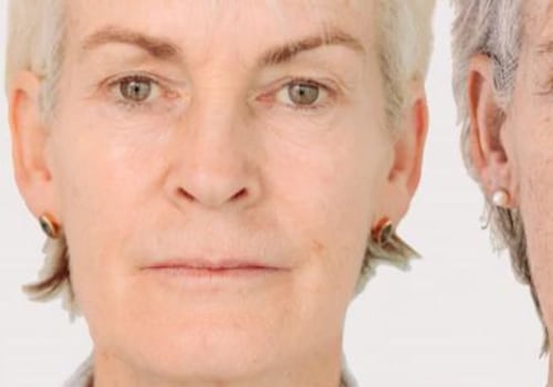 Can Botox Help Reduce Sagging Jowls?