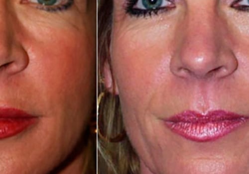 What Happens if Botox is Injected into a Vein?